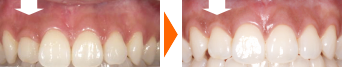 歯ぐきの整形の写真